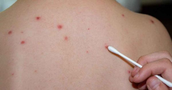 Prohlašují nouzovou situaci v Paraguayu za vypuknutí spalniček - Mercopress